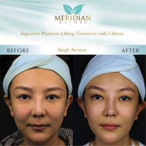 Tong Bing Yu Ulthera Lifting Treatment Aesthetic Clinic Mont Kiara Kuala Lumpur