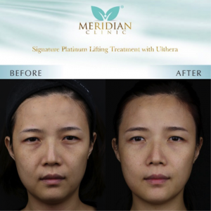 Signature Platinum Lifting Treatment with Ulthera Before & After